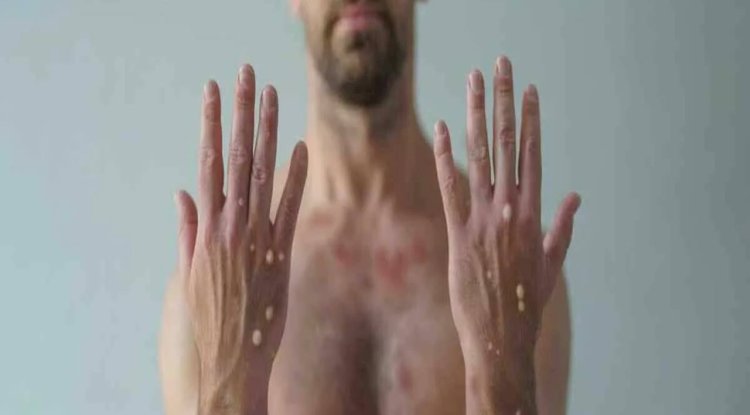 Sağlık Bakanlığı Açıkladı! Maymun Çiçeği Virüsü Türkiye'de Var mı?